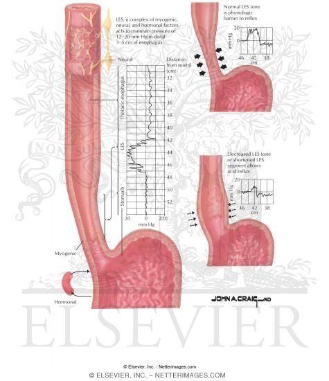 Lower Esophageal Sphincter and Refulx Prevention