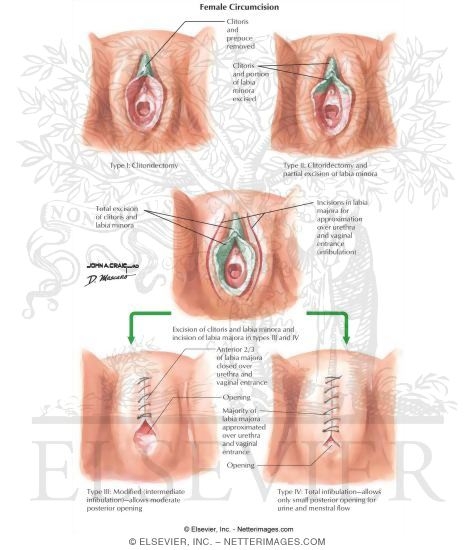 Female Circumcision