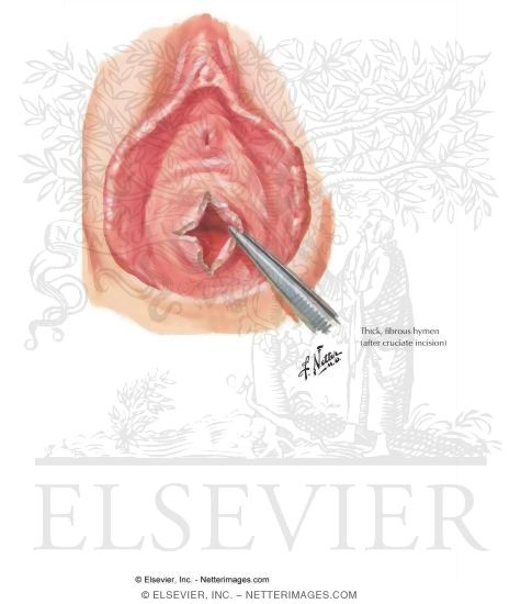 Hymenal Stenosis