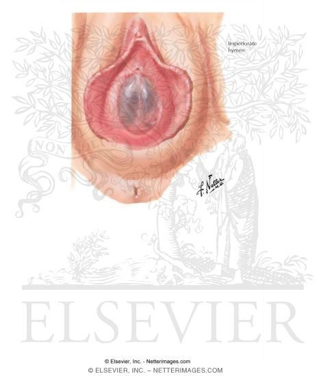 Imperforate Hymen