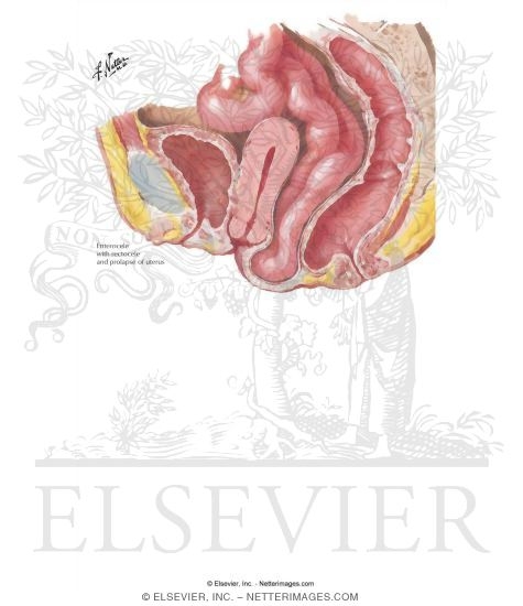 Watermarked preview of labeled image: Enterocele