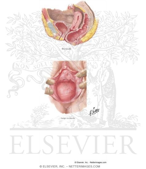 Rectocele