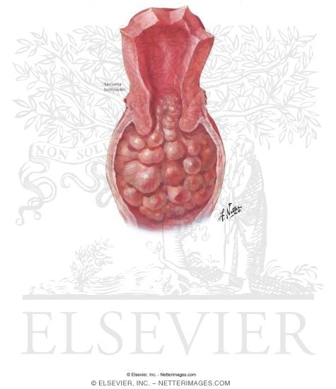 Watermarked preview of labeled image: Sarcoma Botryoides