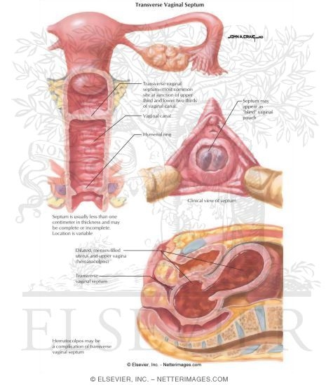 Transverse Vaginal Septum