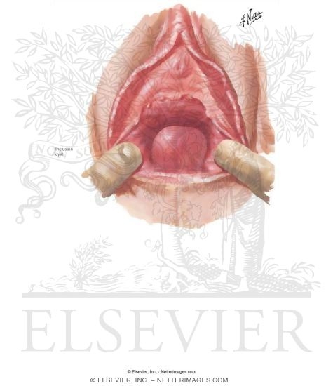 Watermarked preview of labeled image: Inclusion Cyst