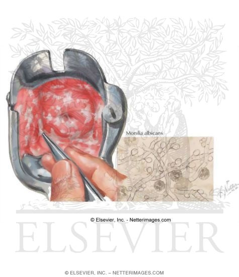 Watermarked preview of labeled image: Vaginitis: Monilial