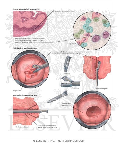 Cervical Intraepithelial Neoplasia
Abnormal Pap Smear: Low and High-Grade Squamous Intraepithelial Lesion