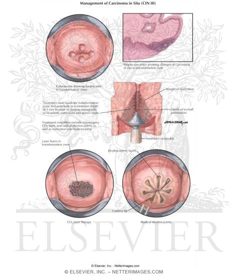 Management of Carcinoma in Situ (CIN III)