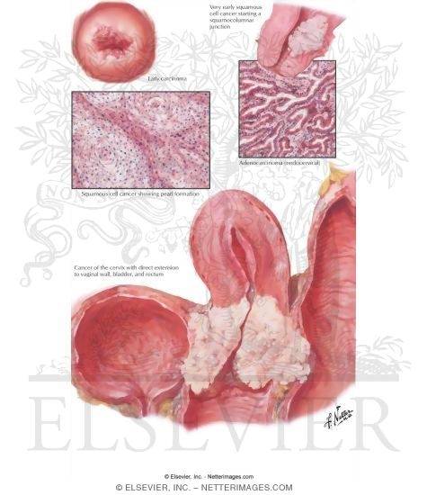 Watermarked preview of labeled image: Cervical Cancer