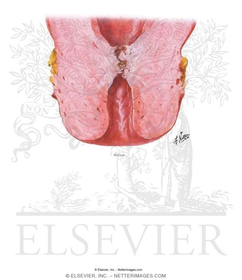 Watermarked preview of labeled image: Cervical Stenosis