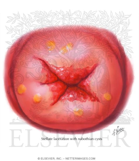 Nabothian Cysts