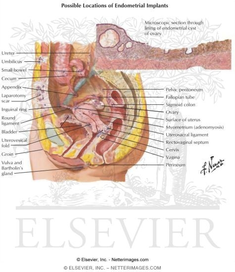 Adenomyosis