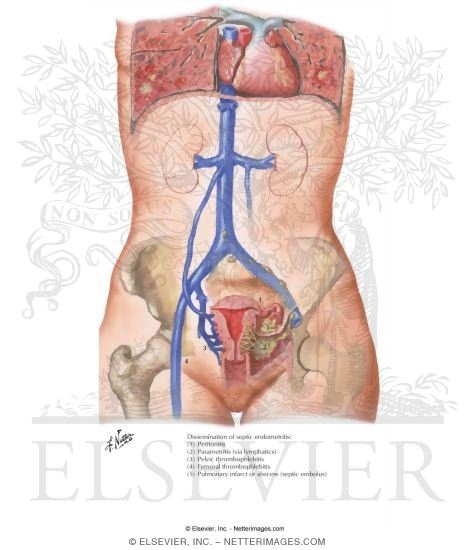 Endometritis
Puerperal Infection