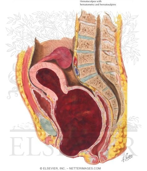 Hematometra