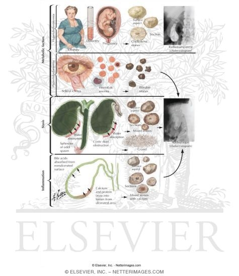 Cholelithiasis I - Stone Formation
Cholecystitis in Pregnancy