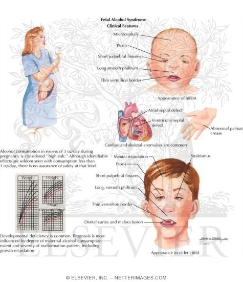 Fetal Alcohol Syndrome