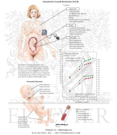 Watermarked preview of labeled image: Intrauterine Growth Restriction (IUGR)
