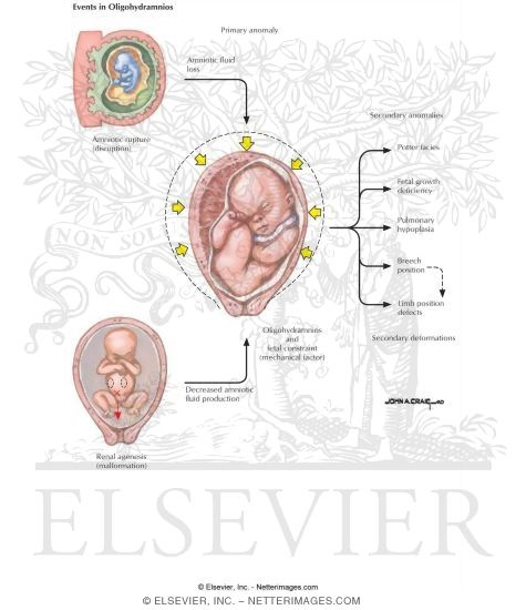 Thesis on oligohydramnios 06 image