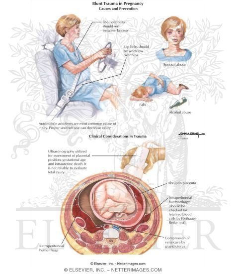 Watermarked preview of labeled image: Blunt Trauma In Pregnancy
Trauma In Pregnancy