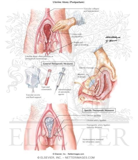 Uterine Atony
Uterine Atony (Postpartum)