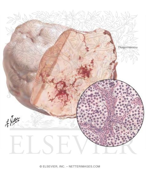 Watermarked preview of labeled image: Dysgerminoma