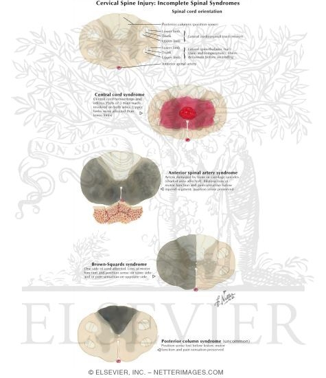 Watermarked preview of labeled image: Cervical Spine Injury: Incomplete Spinal Cord Syndromes