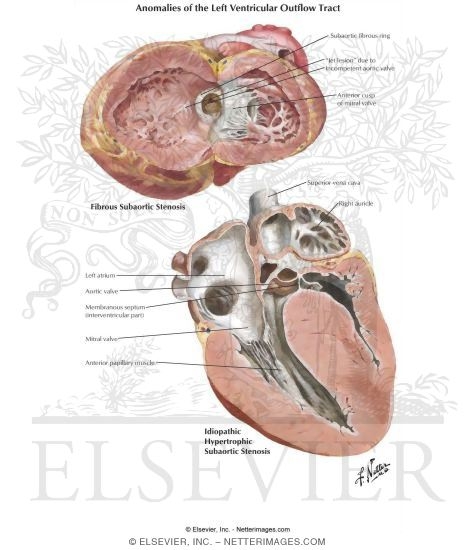 Anomalies of the Left Ventricular Outflow Tract