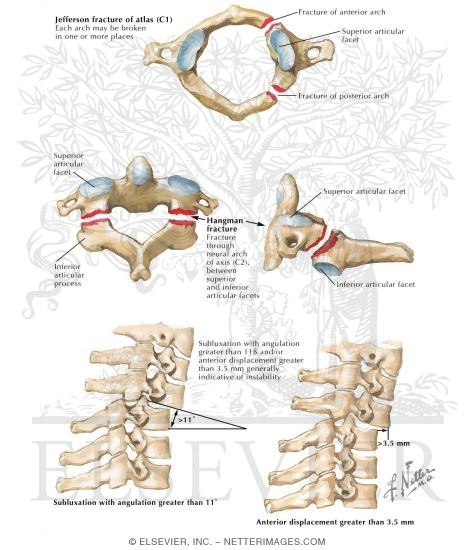 Watermarked preview of labeled image: Spinal Trauma