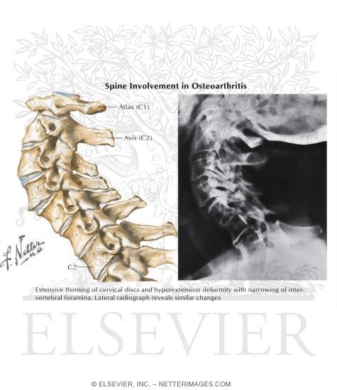 Spine Involvement in Osteoarthritis
Spine