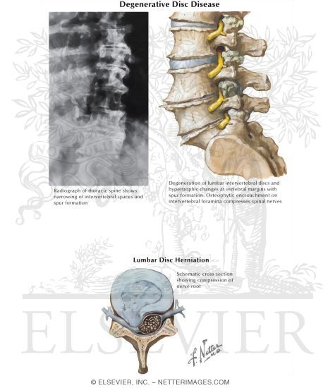 Degenerative Disc Disease