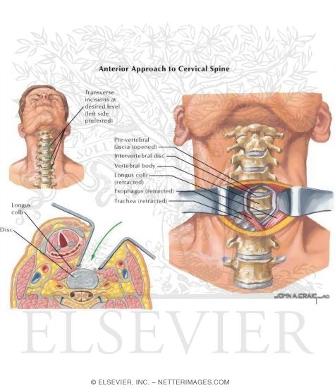 Anterior Approach to Cervical Spine
