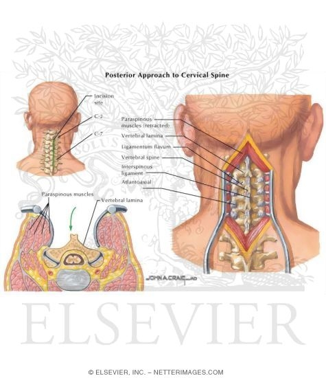 cervical spondylothesis cervical spondylothesis