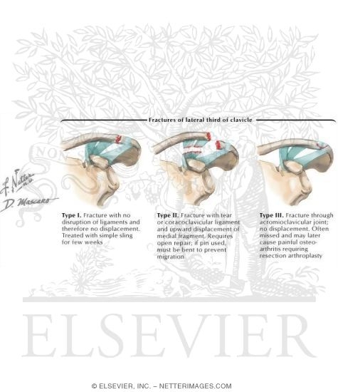 Watermarked preview of labeled image: Fracture of Lateral Third of Clavicle