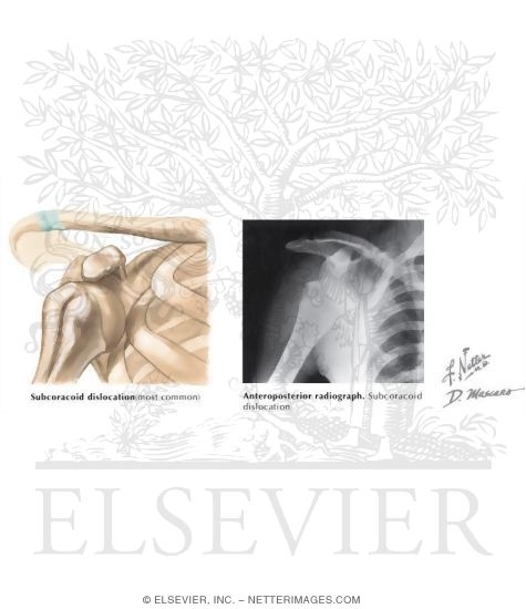 Subcoracoid Dislocation