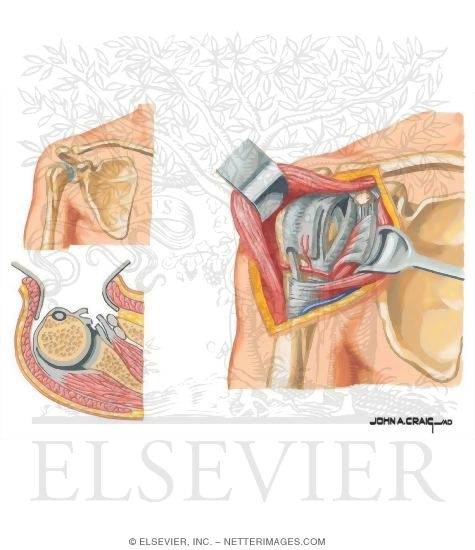 Deltopectoral Approach to Shoulder Joint