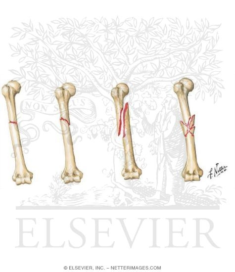Watermarked preview of unlabeled image: Humerus Shaft Fractures