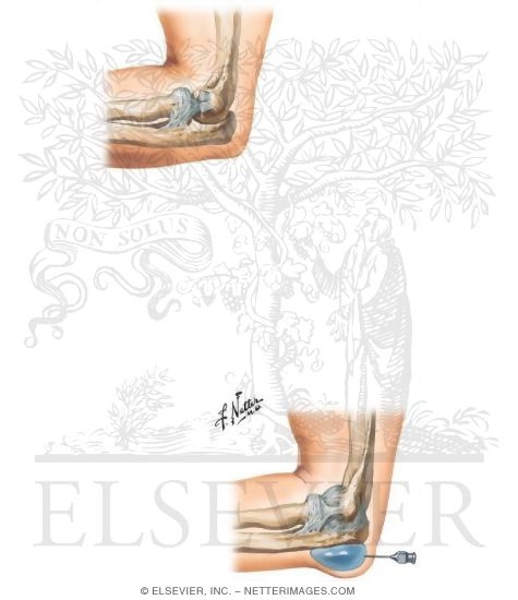 Watermarked preview of unlabeled image: Minor Procedures On the Elbow