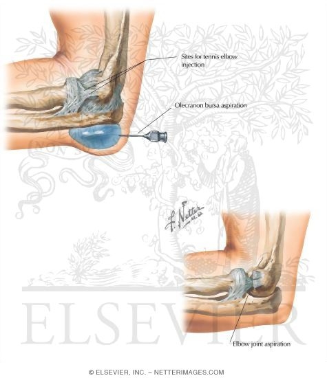 Watermarked preview of labeled image: Minor Procedures On the Elbow