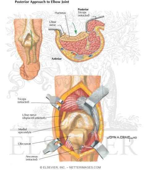 Watermarked preview of labeled image: Surgical Approaches to the Elbow