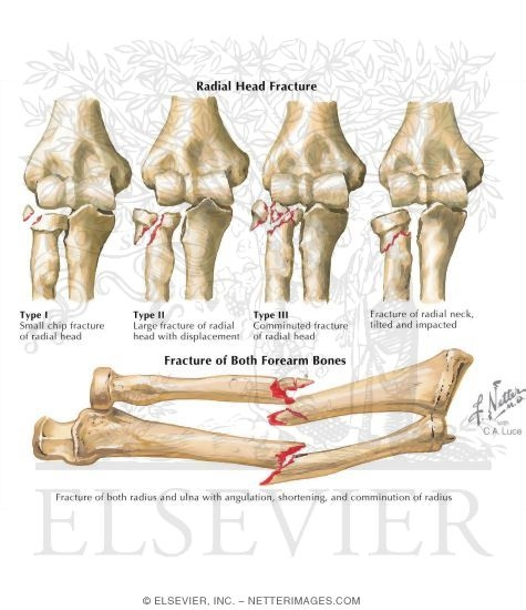 Radial Head Fracture
Fracture of Both Forearm Bones