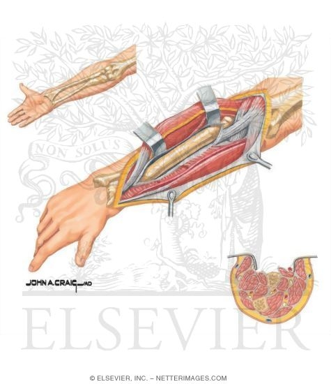 Surgical Approaches to the Forearm