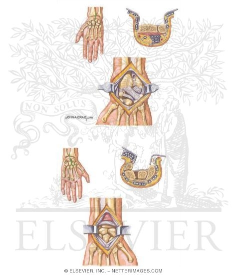 Watermarked preview of unlabeled image: Surgical Approaches to the Wrist