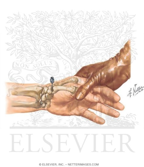 Watermarked preview of unlabeled image: Thumb CMC Injection