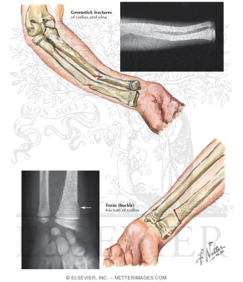Watermarked preview of labeled image: Fracture of the Forearm