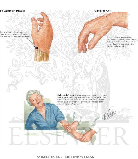 DeQuervain Disease
Ganglion Cyst
Finkelstein's Test