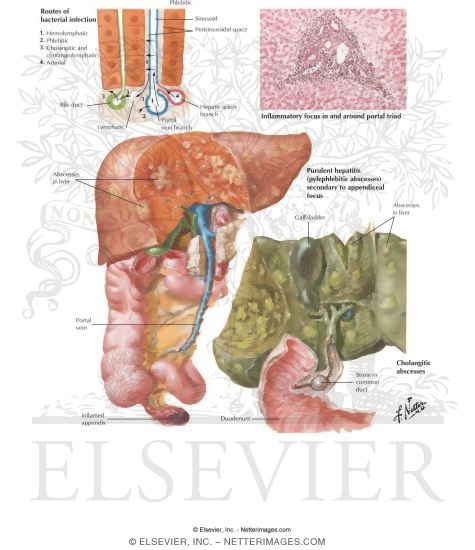 Bacterial Hepatitis