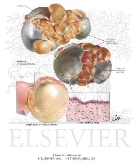 Serous Cystoma, Serous Cystadenoma