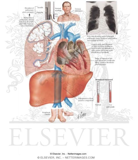 Cor Pulmonale