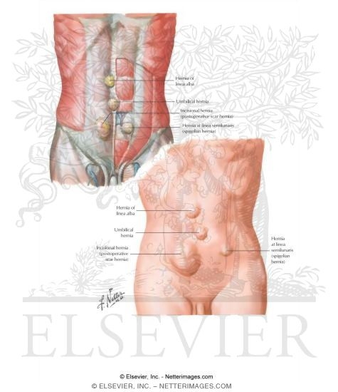 Watermarked preview of labeled image: Hernia IV - Ventral Hernia