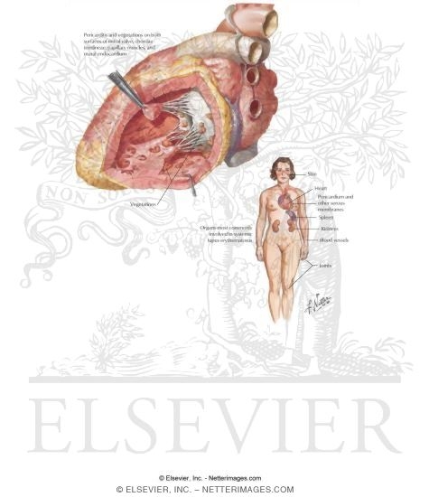 Watermarked preview of labeled image: Lupus Erythematosus